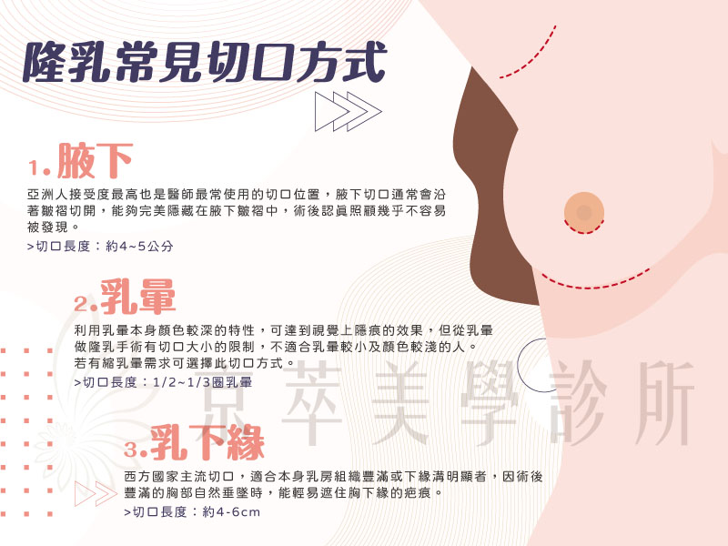 隆乳手術切口位置